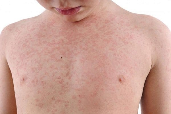 Lịch sử bệnh đậu mùa